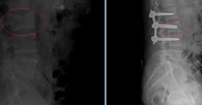 Fractura vertebral L3