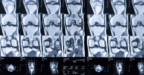 diagnostico rotura meniscal