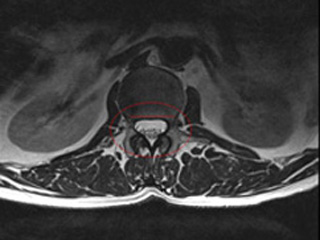 02_estenosis_canal_normal