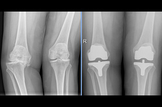 03_total_rodilla